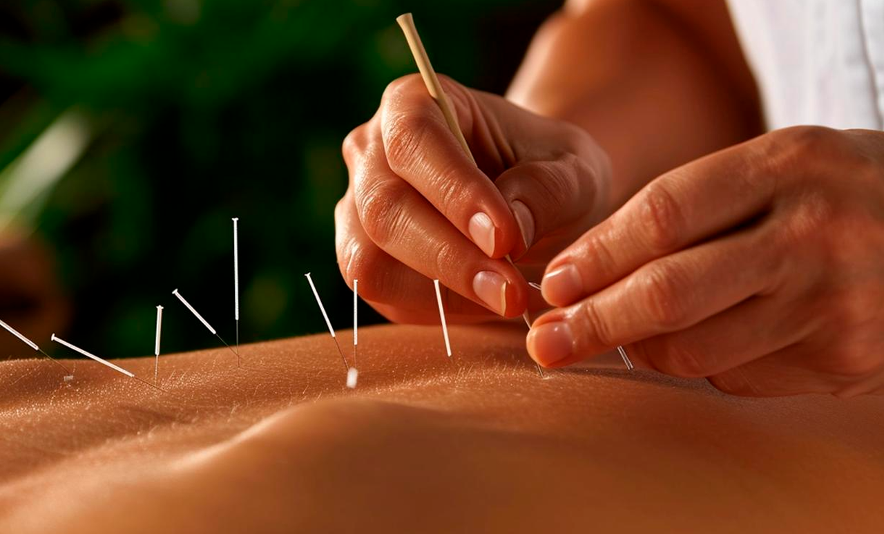 Accupuncture Therapy